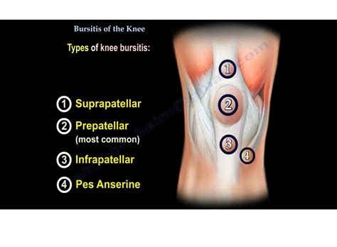 Knee bursitis .